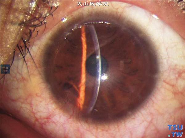 圆锥角膜，左眼行LASEK手术矫正角膜散光，手术后随访4个月，裸眼视力0.6