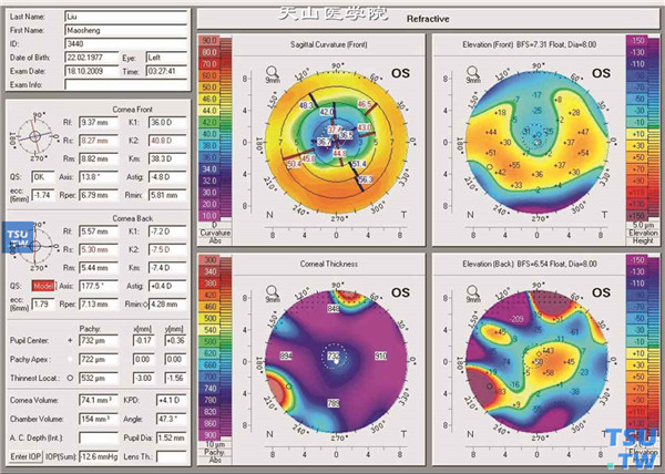 圆锥角膜，左眼LASEK术后角膜地形图检查，可见最陡与最平子午线平均角膜屈光力为40.8/36.0@14°，中央角膜厚度为732 mm