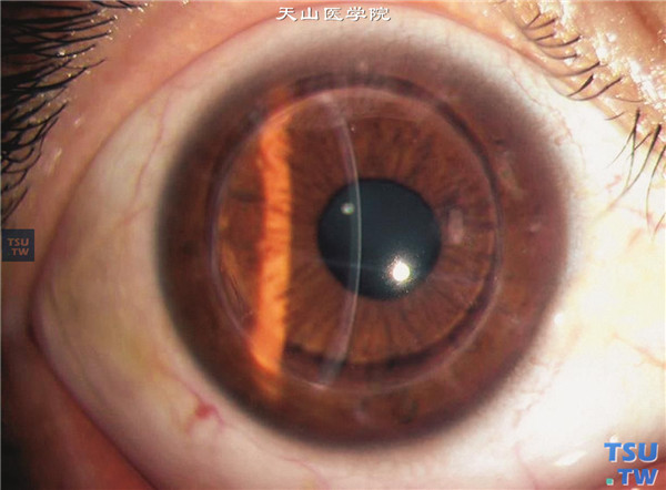 患者急性圆锥角膜，后弹力层破裂，行穿透角膜移植术，术后随访10年，角膜植片仍透明，矫正视力0.8