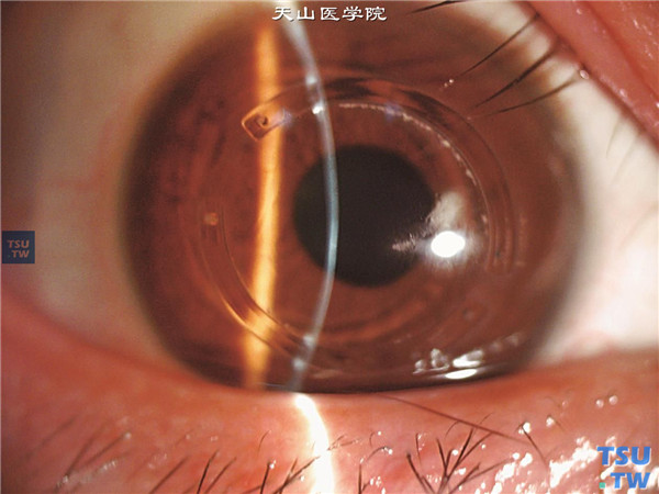 圆锥角膜，上图同一患者，裂隙灯显微镜检查，可见瞳孔区偏下方角膜基质轻度混浊