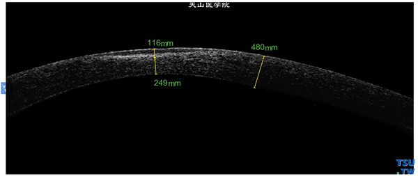 圆锥角膜，上图同一患者，RTvue OCT检查，显示角膜基质混浊位于浅基质层内，呈片状影像改变，角膜明显变薄，上皮层和内皮层影像完整