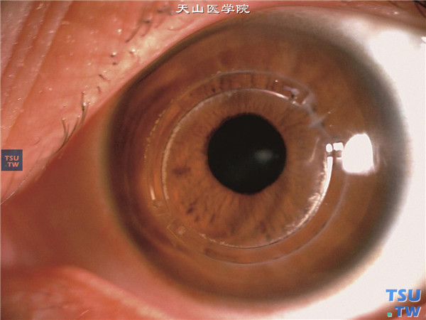 圆锥角膜，上图同一患者左眼，也行角膜基质内基质环植入
