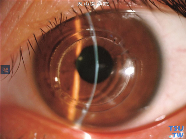 圆锥角膜，左眼裂隙灯显微镜检查，瞳孔中央区角膜局限性混浊