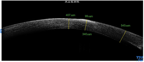 圆锥角膜，左眼RTvue OCT检查，可见角膜混浊区位于上皮下和浅基质层内，中央角膜变薄
