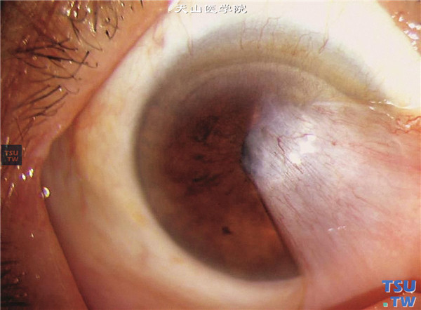 翼状胬肉，可见胬肉组织遮盖角膜瞳孔区，伴有大量新生血管