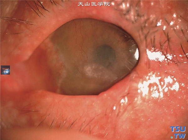 神经麻痹性角膜炎，上图同一患者，因角膜弥漫性上皮剥脱行睑裂缝合术后5个月，眼睑中外1/3粘连愈合，周边新生血管长入，角膜知觉部分恢复