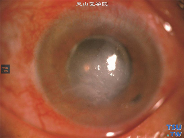 大泡性角膜病变，白内障术后3年，睫状充血，角膜基质水肿，新生血管长入，患者有明显的刺激症状