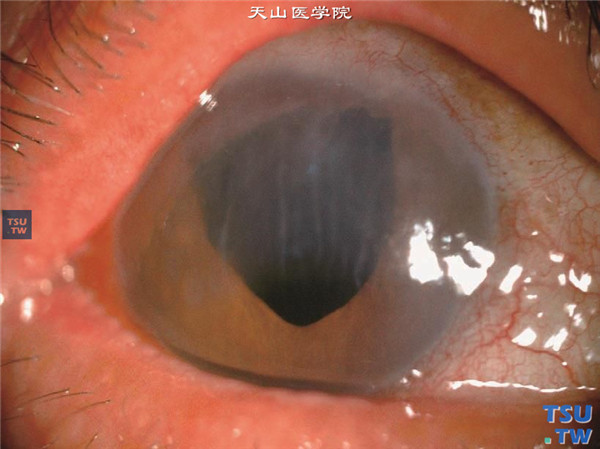 大泡性角膜病变，白内障术后19年，无晶状体，瞳孔上移，角膜内皮细胞功能失代偿，发生大泡性角膜病变，可见上方角膜基质水肿，角膜后弹力层皱褶