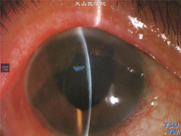 大泡性角膜病变，上图同一患者，裂隙灯显微镜检查，可见角膜上方基质明显水肿增厚，下方角膜厚度基本正常