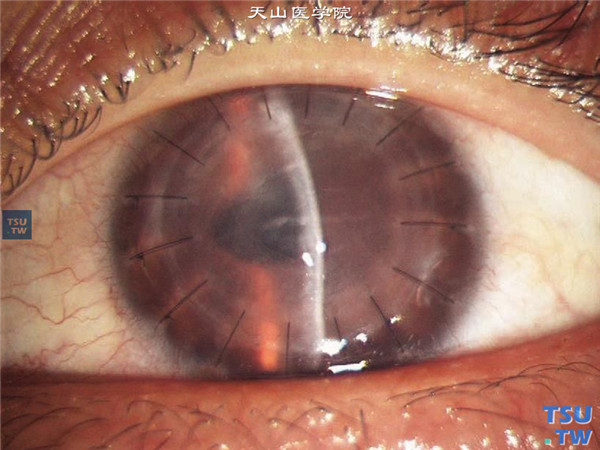 大泡性角膜病变，上图同一患者，裂隙灯显微镜检查，可见角膜植片明显水肿混浊，中央区角膜内皮排斥线