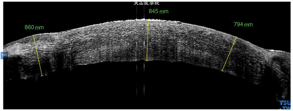 大泡性角膜病变，上图同一患者，RTvue OCT 检查，显示角膜植片明显水肿，增厚，上皮下多发微小水泡，角膜内皮层粗糙，内皮层界线失去连续性