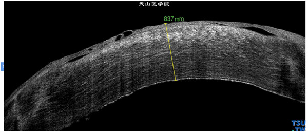 大泡性角膜病变，上图同一患者，RTvue OCT 检查，显示角膜上皮内及上皮下多发水泡，角膜植片明显水肿增厚，角膜内皮层粗糙，内皮层界线失去连续性