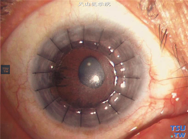 大泡性角膜病变，上图同一患者，行穿透角膜移植术，术后随访后6个月，角膜植片透明