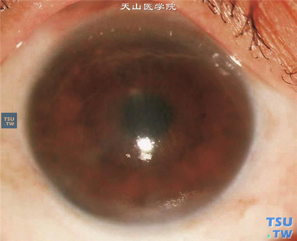 大泡性角膜病变，白内障术后2年，角膜内皮细胞功能失代偿，发生大泡性角膜病变，角膜弥漫性水肿，视力0.02