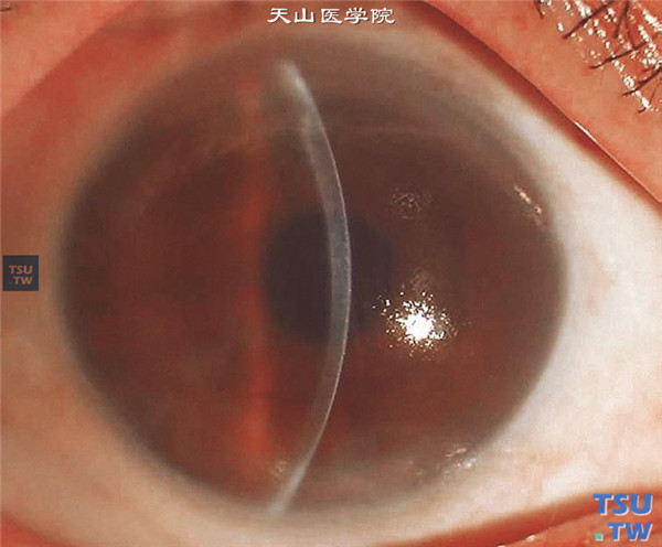 大泡性角膜病变，上图同一患者，裂隙灯显微镜检查，可见角膜基质明显水肿增厚，角膜上皮下水泡