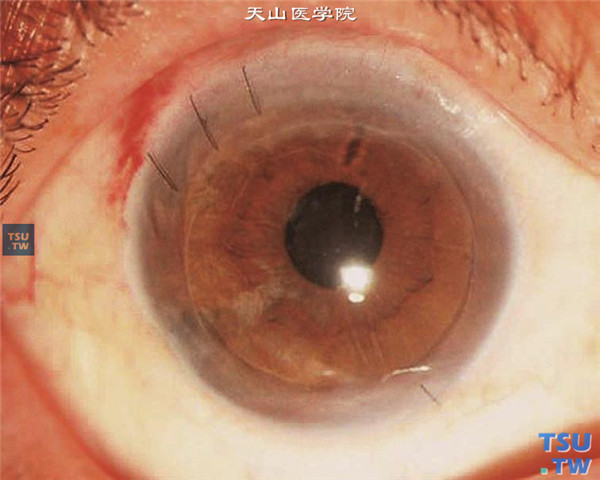 大泡性角膜病变，上图同一患者，行角膜内皮移植术，术后随访6个月，视力0.6，角膜透明