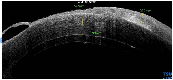 大泡性角膜病变，上图同一患者，RTvue OCT检查，可见角膜植片和植床的界面，角膜上皮下水泡，内皮层欠光滑，角膜明显水肿增厚