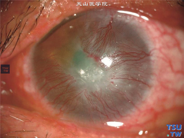暴露性角膜炎，同一患者，可见混合充血，大量新生血管长入，角膜中央区形成无菌性溃疡