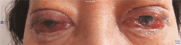 暴露性角膜炎，双眼上睑下垂矫正术后，由于过矫，睑裂闭合不全，双眼角膜继发感染，眼睑和结膜高度水肿，伴有脓性分泌物