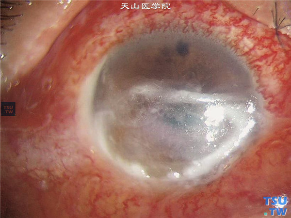 暴露性角膜炎，上图同一患者，右眼角膜发生严重细菌性角膜溃疡，混合充血，溃疡边缘角膜组织混浊坏死