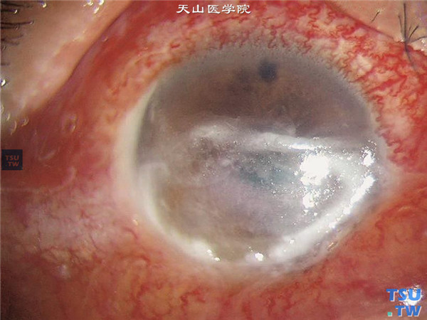 角膜炎瘢痕图片图片