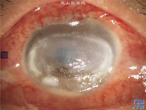 暴露性角膜炎，上图同一患者，左眼角膜病变同右眼相似，结膜明显充血水肿，角膜中下方溶解变薄