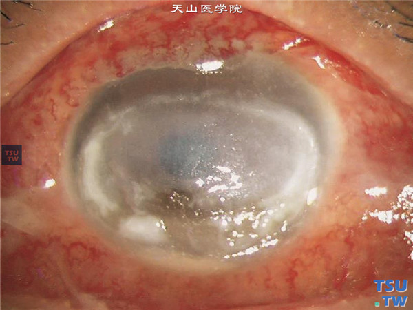 角膜炎发炎照片图片