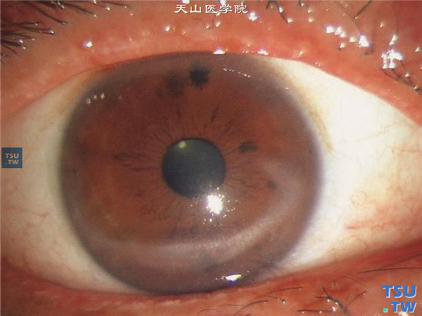 暴露性角膜炎，右眼治疗后