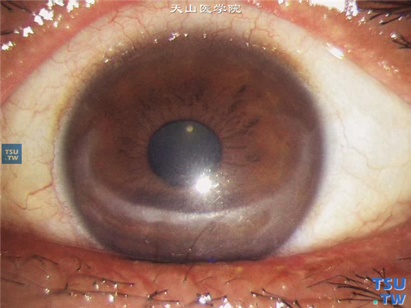 暴露性角膜炎，双眼行额肌瓣松解联合睑裂缝合术，积极抗炎对症治疗3个月，角膜炎症控制，可见双眼角膜下方弧形混浊，角膜上皮完整
