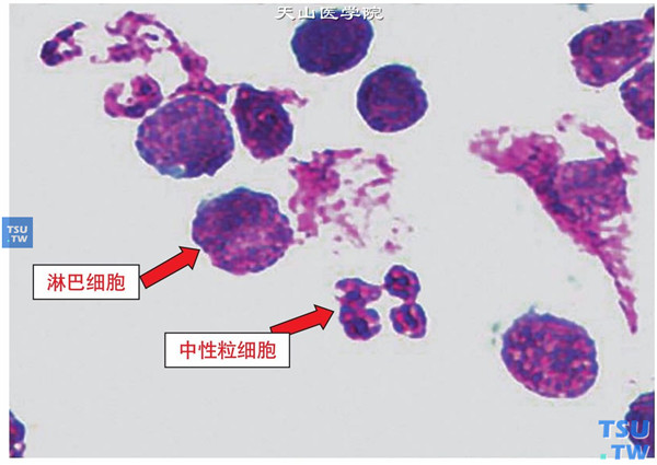 药物性角膜炎，结膜刮片，标本行Wright-Giemsa染色，可见中性粒细胞和淋巴细胞 ×1000