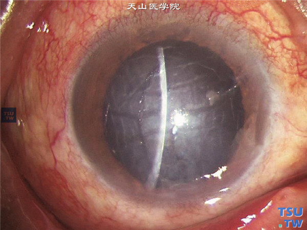 角膜钝挫伤，角膜基质水肿，角膜后弹力层皱褶，内皮层水肿呈龟裂状，瞳孔外伤性散大