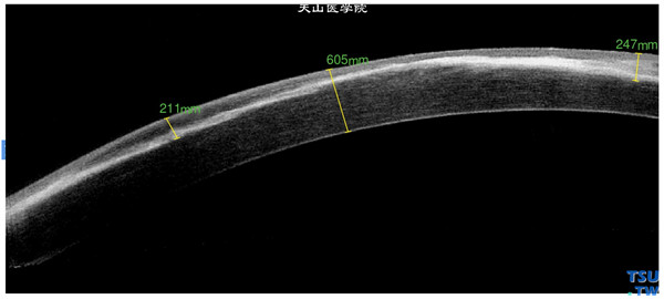 角膜板层裂伤，上图同一患者，RTvue OCT 检查，显示角膜浅层瘢痕，上皮层和内皮层完整