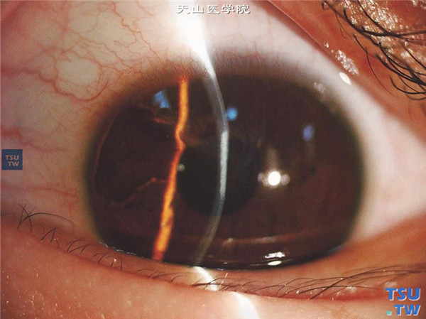 角膜板层裂伤，同一患者，裂隙灯显微镜检查，可见角膜损伤区浅层瘢痕