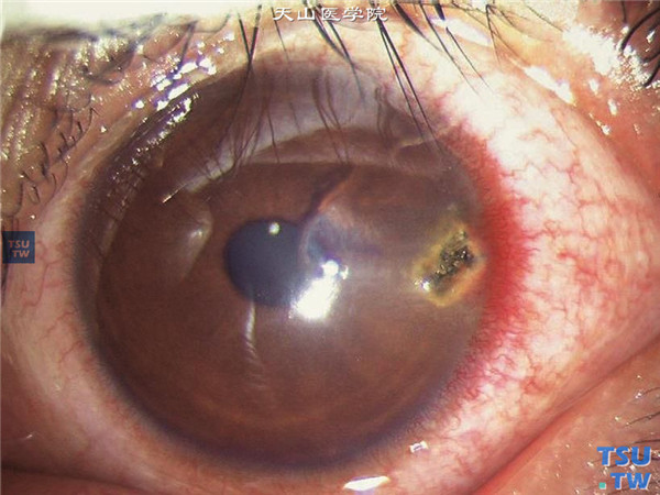 角膜基质内腐烂木质异物，混合充血，异物周围角膜有明显的炎性浸润，角膜水肿