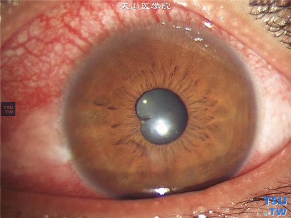 角膜外伤，可见角膜伤口已愈合，晶状体异物