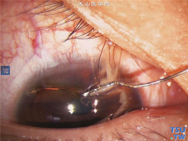 角膜外伤，铁质异物插入角膜，铁丝部分在角膜外