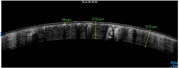 石头炸伤眼睛，同一患者，RTvue OCT检查，角膜异物位于角膜基质层，异物下方有异物伪影的影像