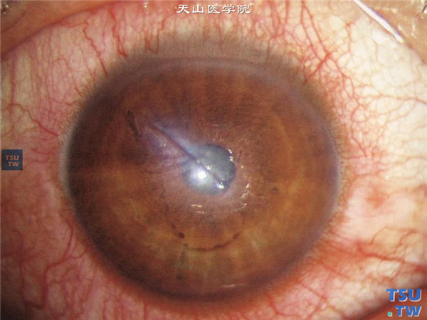 角膜中央穿通伤，可见中央区角膜裂伤波及瞳孔区，伤口周围组织水肿，睫状充血，前房消失
