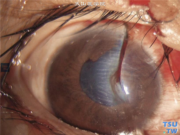 眼角膜穿通伤（角膜破裂）症状图解