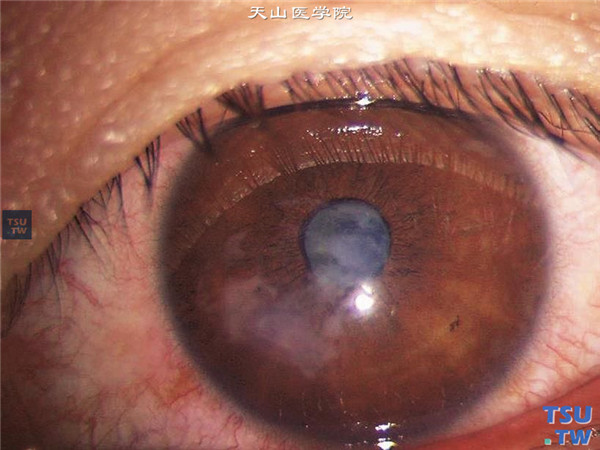 角膜穿通伤，伤口位于瞳孔下缘，外伤性白内障，皮质进入前房