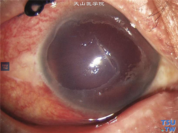 角膜穿通伤，角膜中央可见斜形伤口，伴有大量前房积血，角膜上皮大面积缺损，眼内视不清