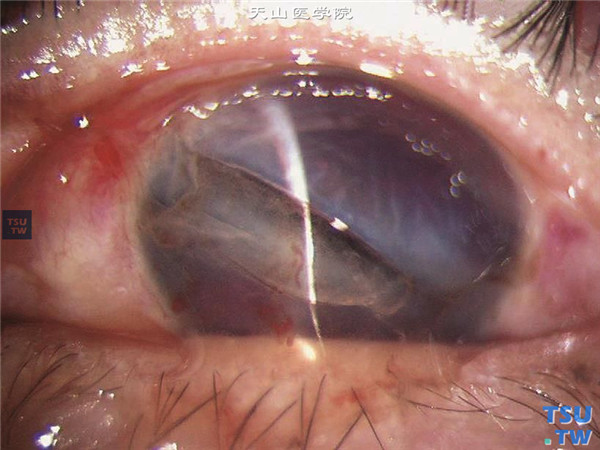 角膜穿通伤，可见横跨全角膜的穿通伤口，角膜水肿，虹膜脱出