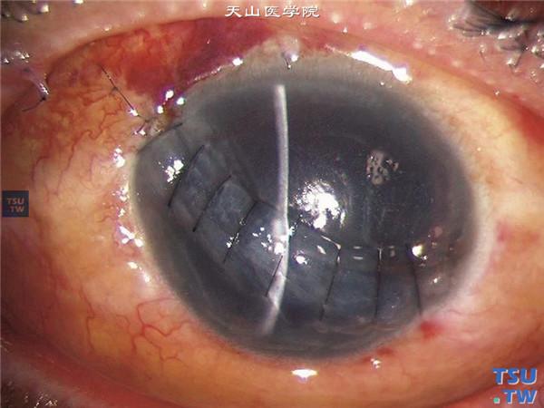 同一患者，行角膜裂伤清创缝合术后6天，角膜伤口对合良好，眼内虹膜组织大部分已丢失，角膜仍水肿