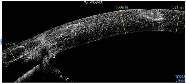 角膜穿通伤同一患者，RTvue OCT 检查，显示裂伤波及角膜全层，虹膜组织嵌顿在伤口中