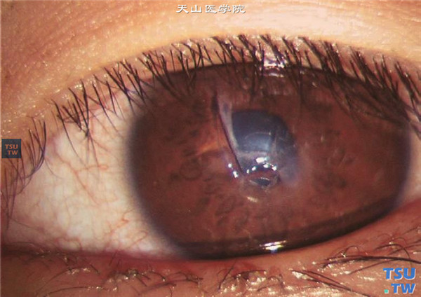 角膜穿通伤，可见角膜中央区三角形裂伤，角膜组织水肿
