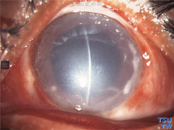 角膜化学伤急性期，中度；以上四张图片显示中度角膜化学伤急性期，可见角膜缘部分缺血，角膜上皮部分缺失，角膜雾状水肿混浊，虹膜纹理欠清