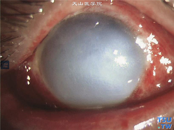 角膜化学伤急性期，重度