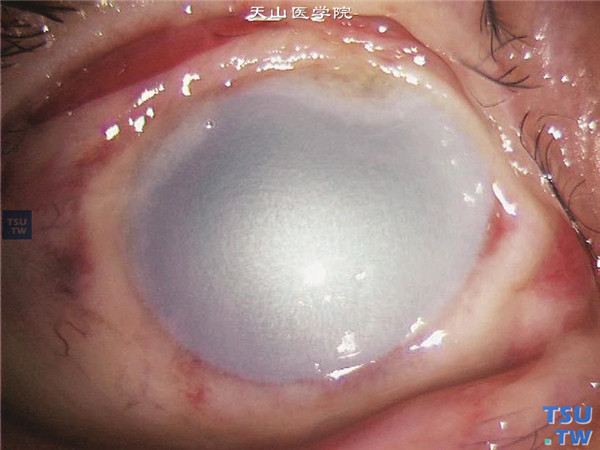 角膜化学伤急性期，重度；以上两张图片显示重度角膜化学伤急性期，角巩膜缘严重缺血，累及全周，角膜基质弥漫性水肿，眼内组织视不清