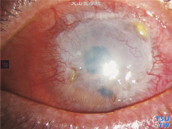 角膜化学伤修复和损伤共存期，以上两张图片显示角膜化学伤修复和损伤共存期，可见缺血的角膜缘重新血管化，新生血管逐渐向角膜中央伸展，中央混浊区逐步被血管膜覆盖