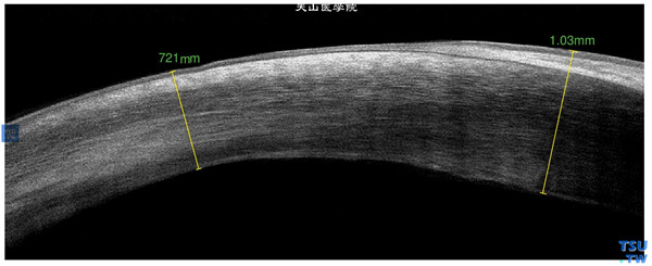 角膜化学伤稳定期，上图同一患者，RTvue OCT检查，可见角膜浅中基质层有弥漫性、角膜表层血管膜状物形成的高密度致密影像，部分深基质层和内皮层大致正常